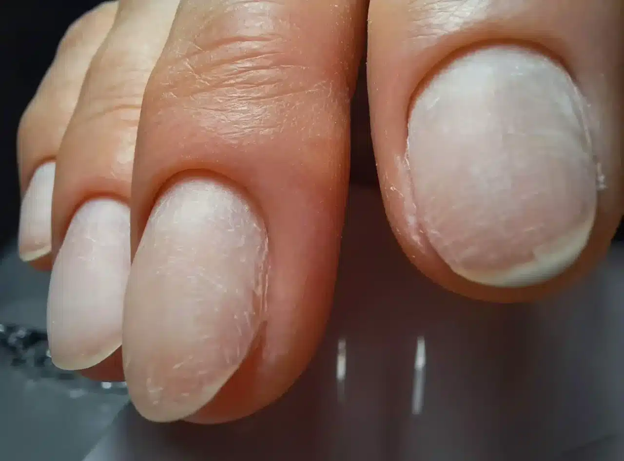 Why do I have sore nails after shellac removal?