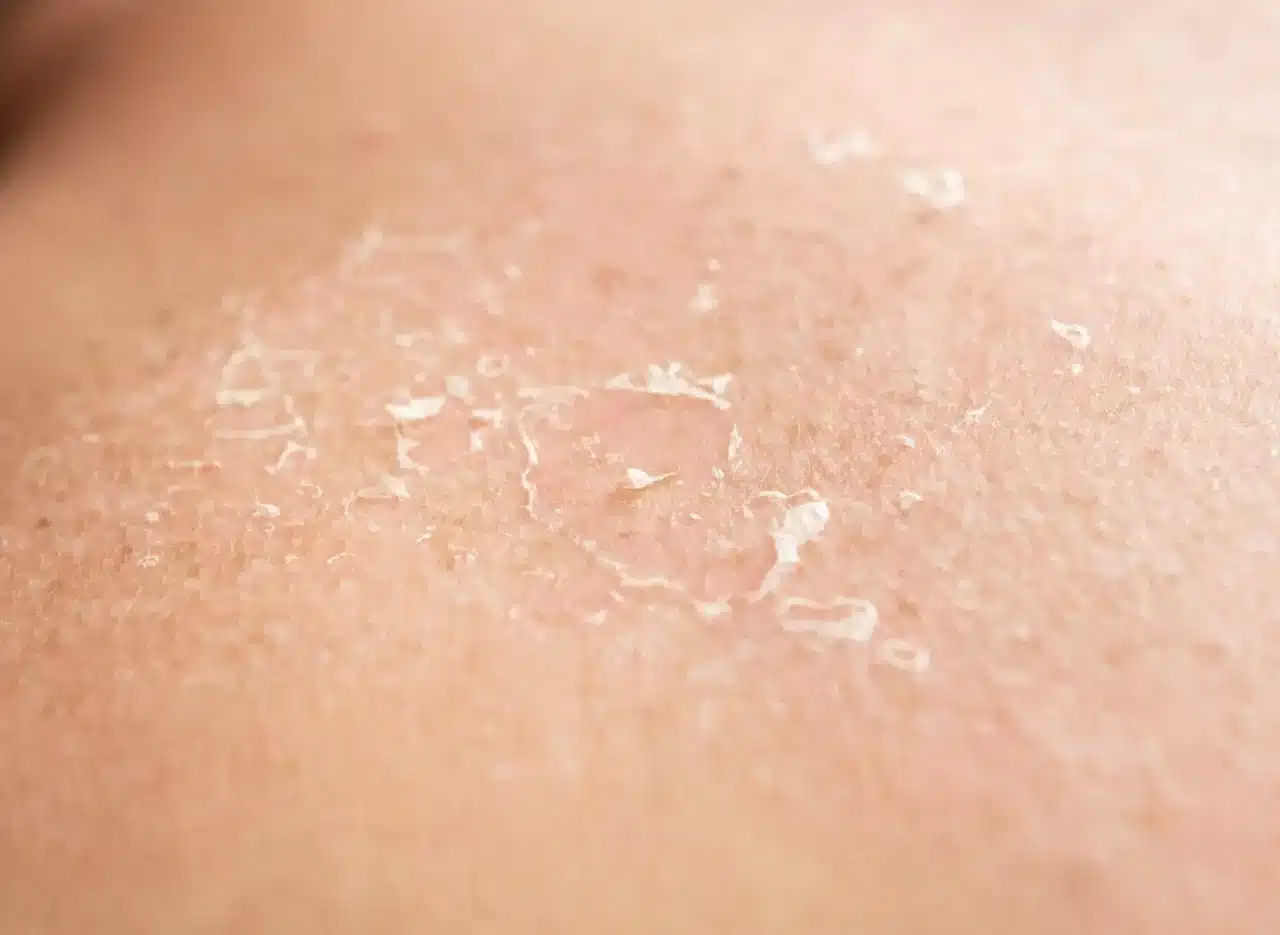 Why does sunburned skin peel in sheets?