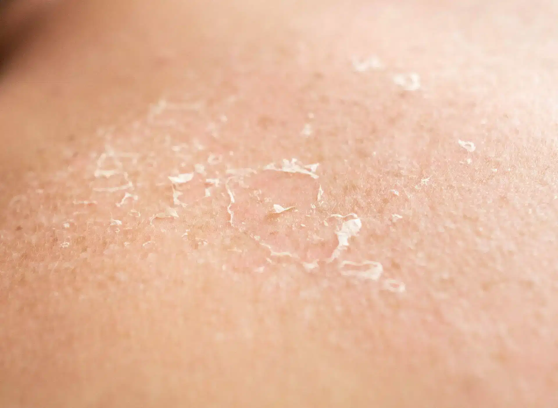 sunburned skin peel in sheets
